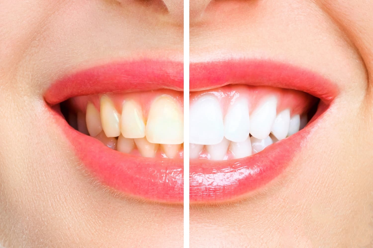 Blanqueamiento dental: preguntas frecuentes
