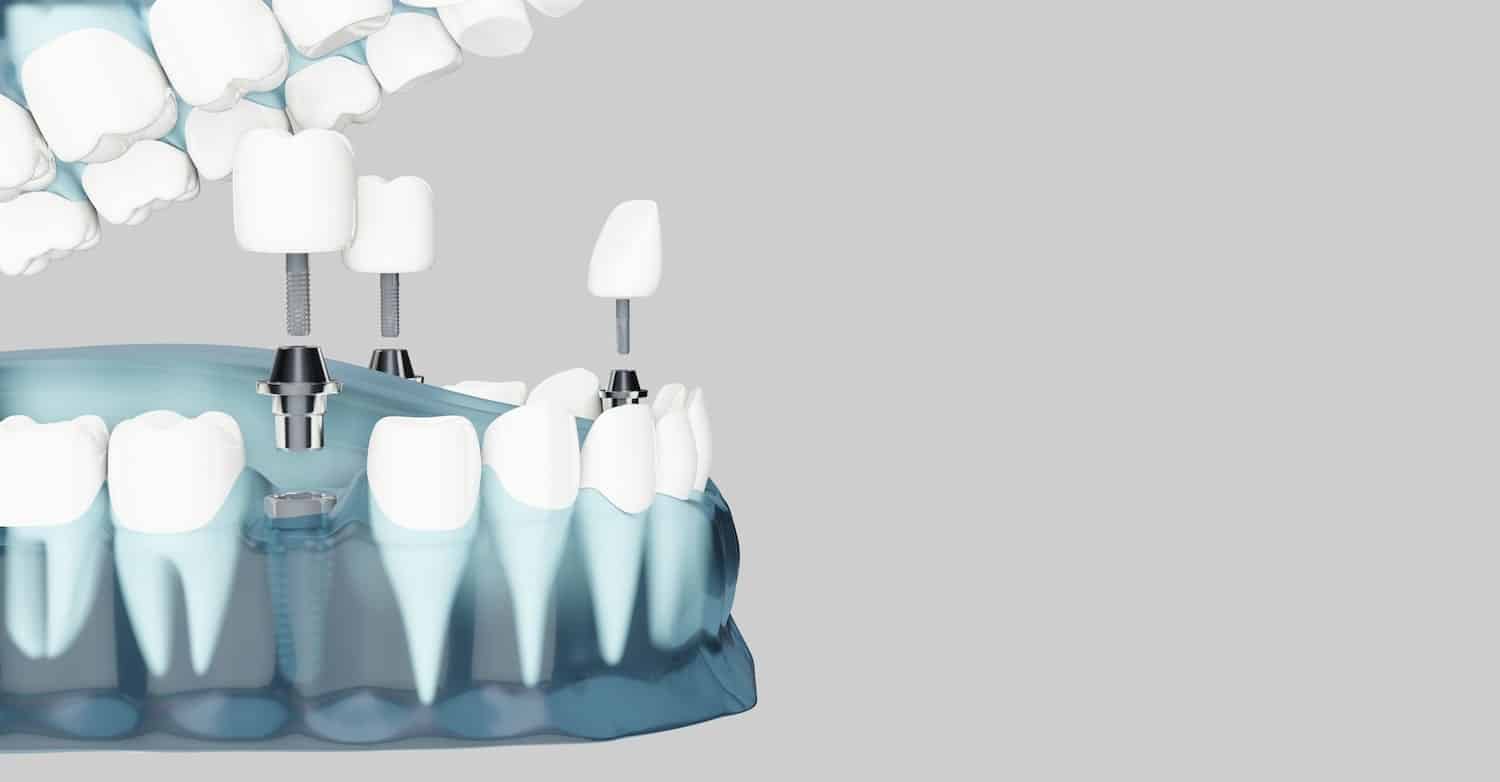 Mitos y leyendas de los implantes dentales